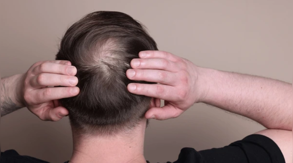Autoimmune alarm: Alopecia areata