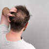 What is an actual bald spot?