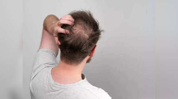 What is an actual bald spot?