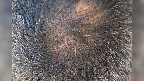 What exactly is a Cowlick?