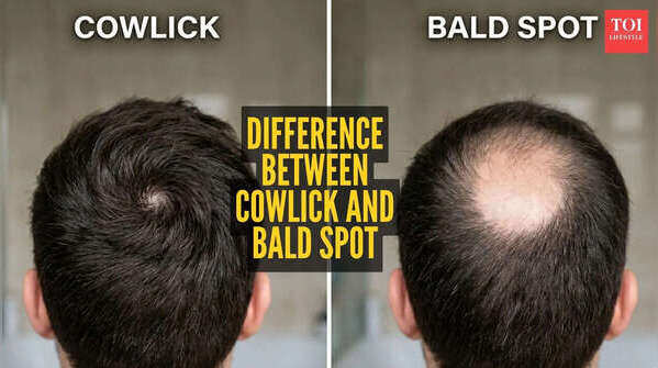 This is how you can differentiate between a cowlick and bald spot