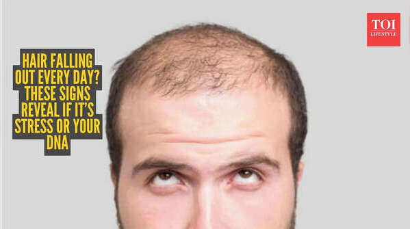 Losing hair every day? Here’s how to tell if it’s just stress or your genes