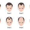 Article image for: Can you test if it’s DHT <i class="tbold">hair loss</i>?