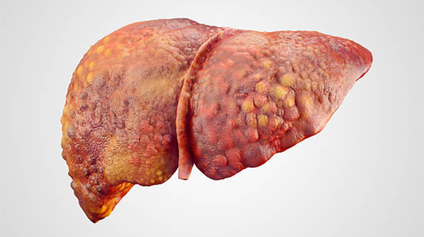 Fibrosis, not steatosis, should be the focus of systematic assessment in diabetes care, says the study. Please explain in simple words.