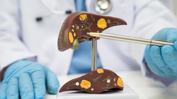 The rise of fatty liver without alcohol