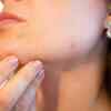 Slower wound or acne healing and repair