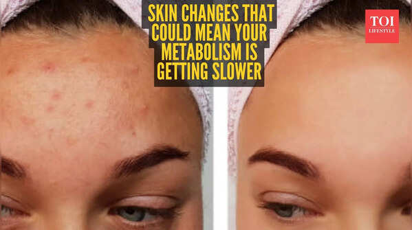 Is your metabolism slowing down? 5 skin signs to watch for
