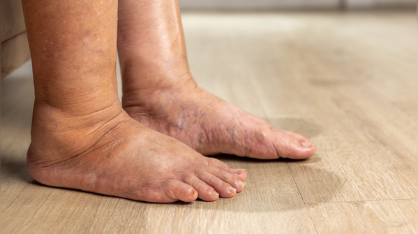 Swelling, heaviness, and tired legs