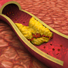 LDL is not just ‘bad’, it has layers