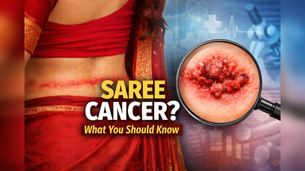 All we need to know about 'Saree Cancer'