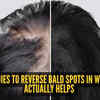 Article image for: Alopecia Areata remedies: Home remedies to reverse bald spot in women