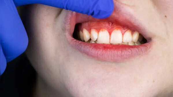 Sensitive and bleeding gums