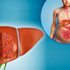 Article image for: How to stay a step ahead of silent liver damage