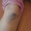 Bruises that appear too easily