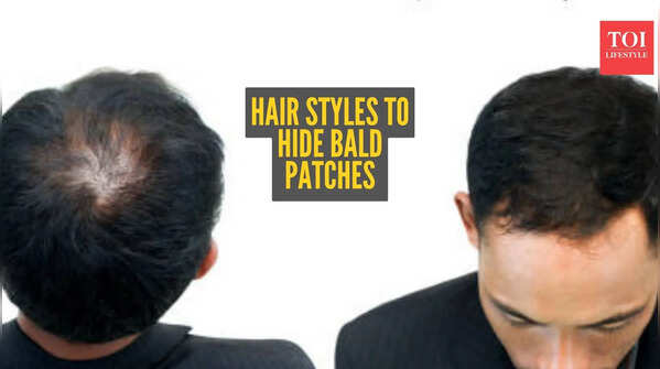 Hairstyles to hide Alopecia patches naturally