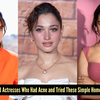 Article image for: <i class="tbold">journey</i> from acne to clear skin