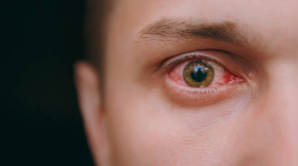 What actually happens when you get an eye infection
