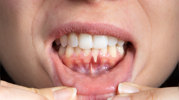 Brushing harder does not mean cleaner