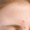 Article image for: But why is the forehead the first victim?