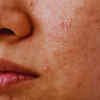 Article image for: 5 hidden nutritional deficiencies that trigger skin pigmentation in women
