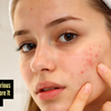 Article image for: Summer breakouts getting out of control?