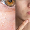 Article image for: Stage <i class="tbold">1</i>: Mild to moderate acne