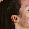 Article image for: Stage <i class="tbold">2</i>: Severe inflammatory acne