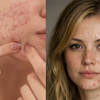 Article image for: Stage 3: Hormonal and chronic acne