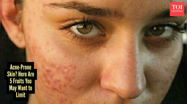 Can fruits cause acne?