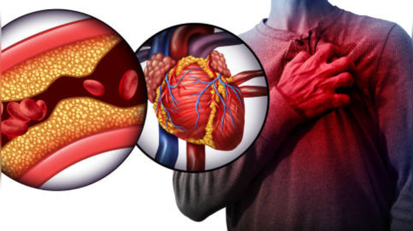 Chest pain or discomfort