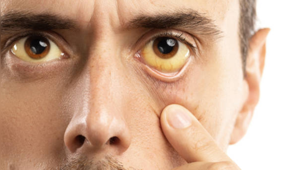 Yellowing of the skin and/or eyes (Jaundice)