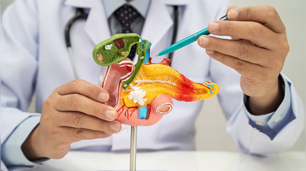 Pancreatic cancer does not cause noticeable symptoms
