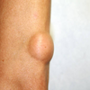Bumps and lesions under your skin