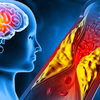 Young adults are increasingly affected by high cholesterol these days