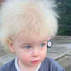 Article image for: Uncombable <i class="tbold">hair</i> syndrome (UHS)