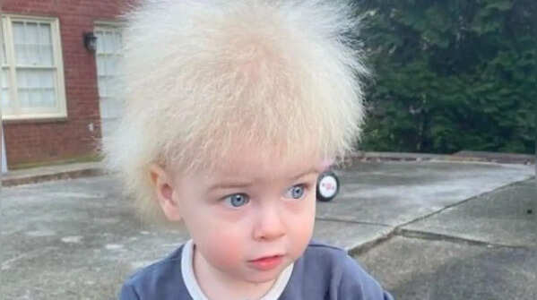 Uncombable hair syndrome (UHS)