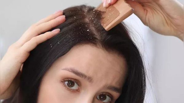 Sending Dandruff Packing