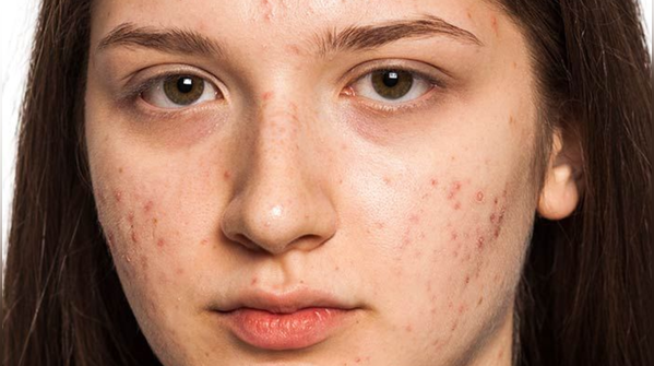 The Natural Fix For Scars