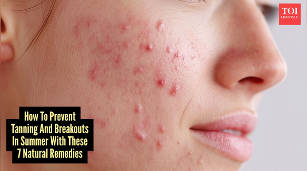 Best Summer Skincare Remedies