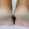 When cracked heels become painful and dangerous