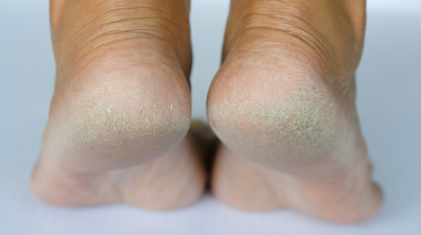 When cracked heels become painful and dangerous