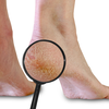 Why some people get cracked heels and others do not