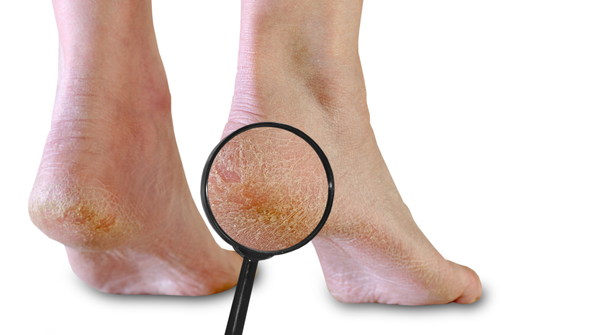 Why some people get cracked heels and others do not
