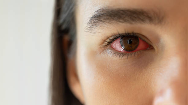 Uncorrected refractive errors