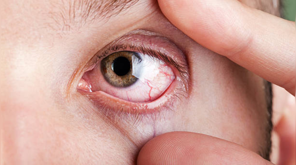 Impact of reduced vision on daily life