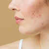 ​Spotting the signs: What does "Whey Acne" look like?