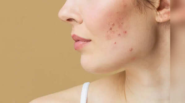 Spotting the signs: What does "Whey Acne" look like?
