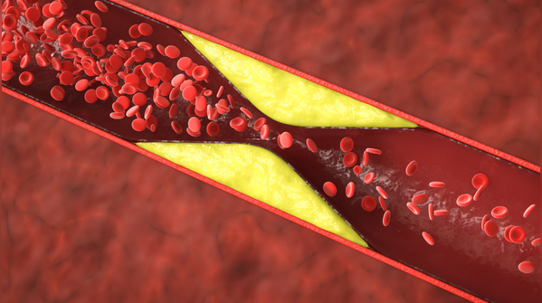The cholesterol question