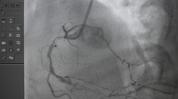 Stress tests and ECGs help doctors understand severity