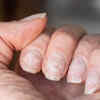 Brittle nails, dry skin, thin hair